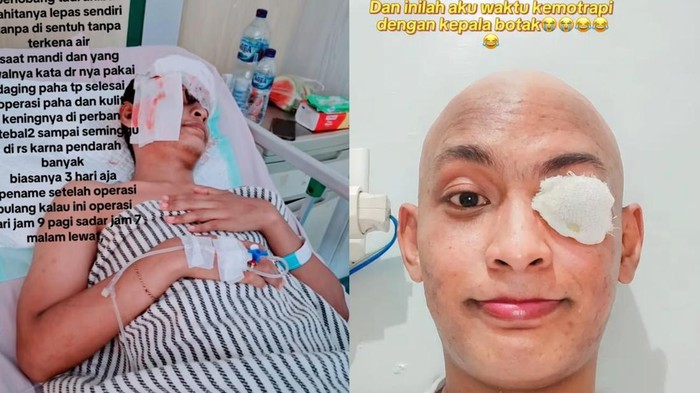 Kanker mata pria di medan