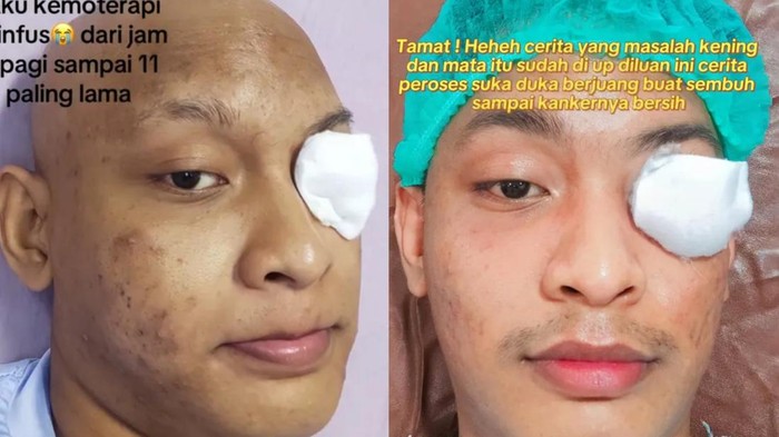 Kanker mata pria di medan