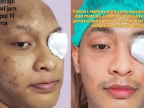 Awal Mula Pria Medan Angkat Bola Mata karena Kanker, Ini Gejalanya