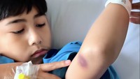 Muhammad Bambang Arr Reybach, putra Bebi Romeo dan Meisya Siregar mengalami lebam-lebam di tubuhnya. Ini bukan karena jatuh atau terpentok benda tumpul dan keras, melainkan karena jumlah trombositnya 3.000 dengan normal sekitar 150 ribu. Jadi harus diopname karena sudah terjadi pendarahan di dalam. (Foto: Instagram @meisya__siregar)