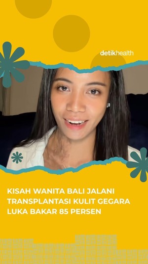 Video Kisah Wanita Bali Jalani Transplantasi Kulit Imbas Luka Bakar 85%