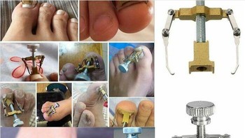 Alat pelurus kuku yang bikin ngilu duluan Fungsinya membantu mengoreksi kuku yang tumbuh ke dalam, tapi bentuknya sukses bikin siapa pun refleks meringis. Foto: Boredpanda