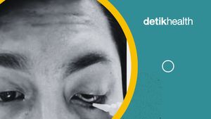 Video: Viral Pria Medan Kena Kanker, Bola Mata Harus Diangkat