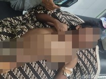 Anjing Liar Kembali Serang Anak di Lombok Timur, Korban Luka Sekujur Tubuh