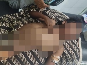 Anjing Liar Kembali Serang Anak di Lombok Timur, Korban Luka Sekujur Tubuh