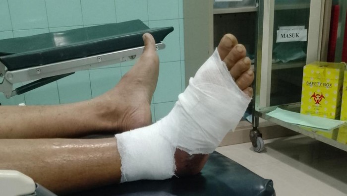 Kondisi kaki Suradi, warga Siasem, Brebes, yang digigit ular berbisa jenis gibug usai mendapat penanganan. Foto diunggah Senin (20/4/2026).