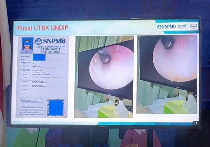 Salah satu modus kecurangan dalam UTBK SNBT 2026 di Undip dengan menanamkan alat bantu dengar di lubang telinga