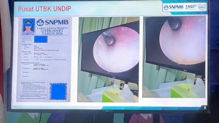 Salah satu modus kecurangan dalam UTBK SNBT 2026 di Undip dengan menanamkan alat bantu dengar di lubang telinga