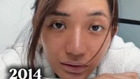 Berlliana Lovell memperlihatkan kondisi wajahnya di 2014 saat berjuang melawan kanker payudara. Ini aku habis kemo. Badan aku ngilu banget. Aku capek kalau aku harus kuat terus, ujarnya dilihat di Instagram, Sabtu (25/4/2026). (Foto: dok Instagram berlliana.lovell)