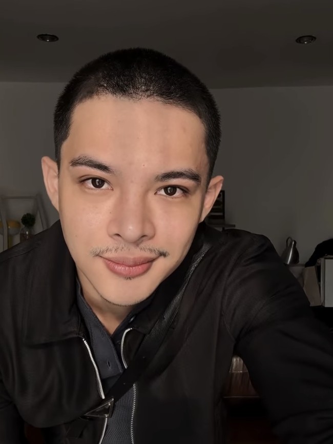 Rey Mbayang Idap Autoimun Psoriasis