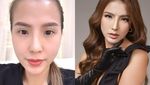 Before-After Angela Tee Oplas Hidung Rp 300 Juta
