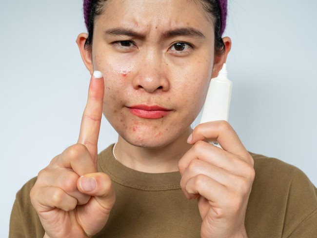 Salep Obat Jerawat