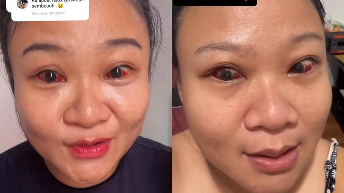 Viral mata wanita Pontianak memerah setelah melahirkan.