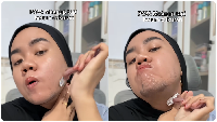 Viral Gadis 23 Tahun di Madura Tumbuh Brewok, Ternyata Idap Kondisi Ini