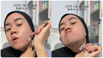 Viral Gadis 23 Tahun di Madura Tumbuh Brewok, Ternyata Idap Kondisi Ini