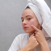 Jangan Salah Pilih, Ini Skincare untuk Kulit Sensitif, Berminyak & Berjerawat