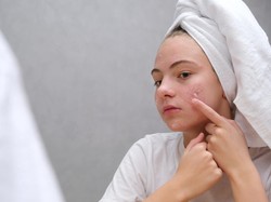 Jangan Salah Pilih, Ini Skincare untuk Kulit Sensitif, Berminyak & Berjerawat