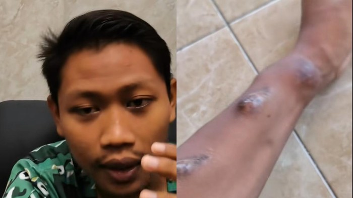 Pengidap gagal ginjal kronis di usia 20-an.