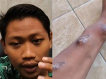 Cuci Darah 700 Kali, Ini Awal Pemuda Tuban Gagal Ginjal gegara Mi Instan