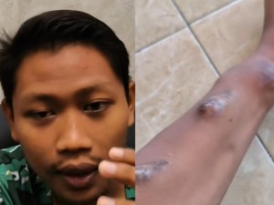Viral Cerita Pria Tuban Cuci Darah di Usia 20-an, Begini Kondisinya Sekarang