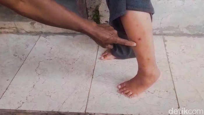 warga menunjukkan serangan nyamuk yang bikin bentol dan luka kehitaman
