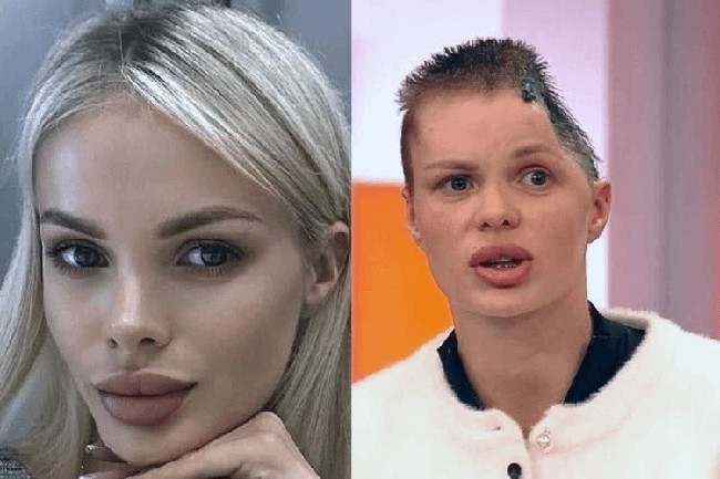 Empat bulan lalu, Anzhelika akhirnya muncul di televisi untuk pertama kalinya dan menceritakan kondisi yang dialaminya setelah serangan brutal tersebut. Foto: dok. Instagram