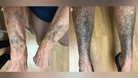 Minum Antibiotik untuk Jerawat, Kulit Wanita Ini Malah Berubah Jadi Hitam-Biru