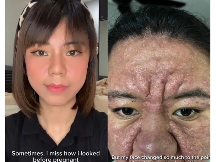 Kisah haru perjuangan wanita ini pulihkan kulit wajahnya yang berubah akibat hormon kehamilan. Ia tetap bertahan dan ingatkan wanita untuk mencintai diri.
