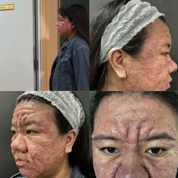 Kisah haru perjuangan wanita ini pulihkan kulit wajahnya yang berubah akibat hormon kehamilan. Ia tetap bertahan dan ingatkan wanita untuk mencintai diri.