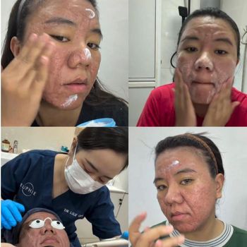 Kisah haru perjuangan wanita ini pulihkan kulit wajahnya yang berubah akibat hormon kehamilan. Ia tetap bertahan dan ingatkan wanita untuk mencintai diri.