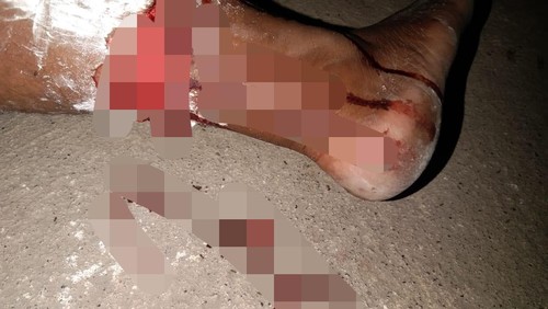 Salah satu warga di Desa Oelfatu, Kecamatan Amfoang Barat Laut, Kabupaten Kupang, NTT, digigit anjing diduga rabies di kaki kanannya, Senin (18/5/2026).