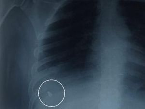 Peluru di Tubuh Satpam SPPG Korban Begal di Deli Serdang Sudah Diangkat