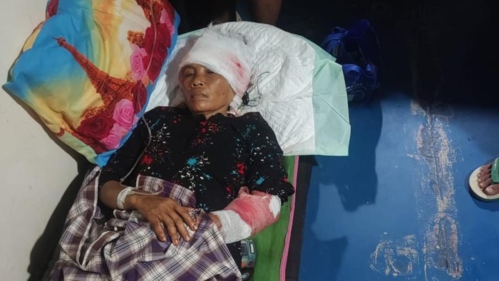 Emak-emak bernama Wa Gobe (53) dirawat dengan luka-luka usai berhasil selamat dari gigitan buaya di Muna.