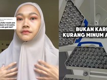 Dokter Beberkan Beda Wajah Khas Gagal Ginjal dengan Kondisi Biasa