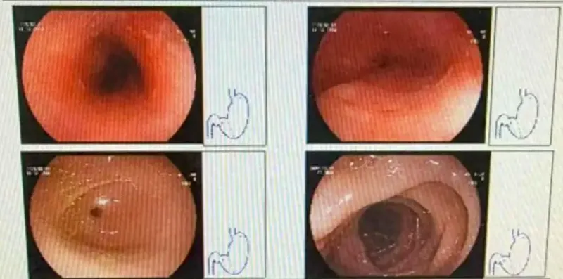 Gegara Makan Hotpot Panas, Kerongkongan Wanita Ini Luka Sepanjang 8 Cm
