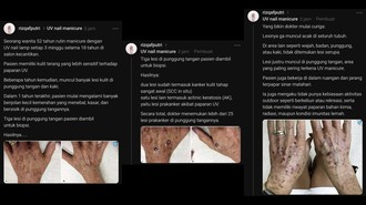 Viral Wanita Kena Kanker Kulit Disebut karena Sering Manicure, Dokter Angkat Bicara