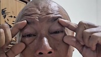 Lur mataku pie to, masih benjol. Nah ini tadi kesembur bisa kobra. Ini bisanya sih udah nggak anu, sudah keluar, cuma tadi sempat kena saraf-sarafnya. Penanganan sudah benar dilinang dengan air mengalir, ini tinggal pemulihan, cerita Heru memperlihatkan matanya. Foto: Instagram @heru.gundul