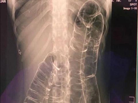Kasus langka usus sembelit Kasus langka usus naik ke dada karena sembelit