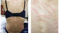 Makan Jamur Shiitake, Punggung Wanita Ini Dipenuhi Ruam Mirip Bekas Cambukan