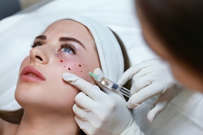 Woman having dark undereye circles and undergoing hylauronan acid treatment done to prevent it