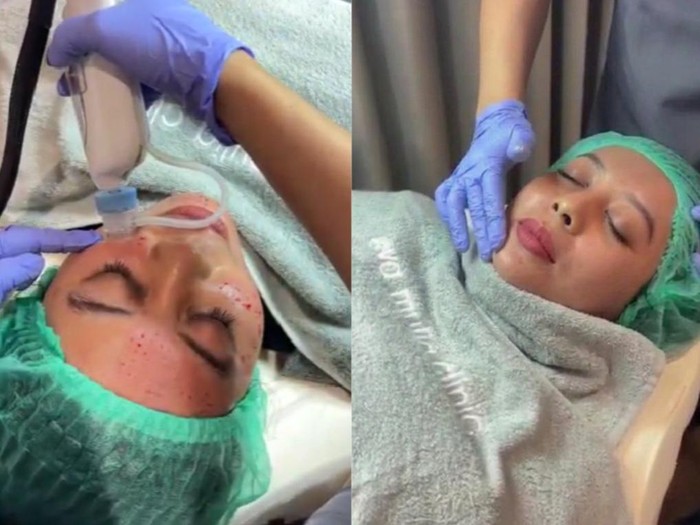 Woman having dark undereye circles and undergoing hylauronan acid treatment done to prevent it