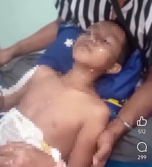 Tangkapan layar salah satu korban mengalami luka bakar saat dirawat di rumah sakit. Foto: (akun Facebook@Tiara Erna BenKinara Cahya)