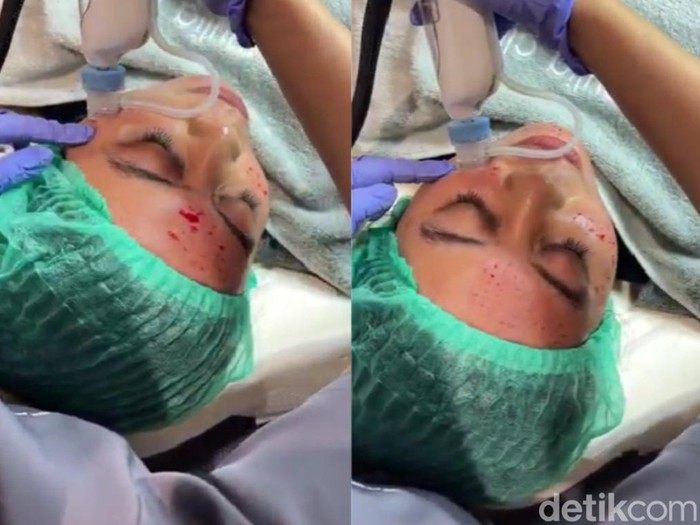 Woman having dark undereye circles and undergoing hylauronan acid treatment done to prevent it