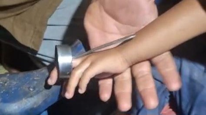 Jari balita laki-laki yang tersangkut tutup botol suvenir di Kajar I, Karangtengah, Wonosari, Gunungkidul.