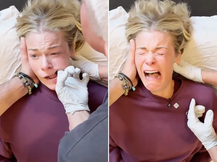 LeAnn Rimes terapi rahang