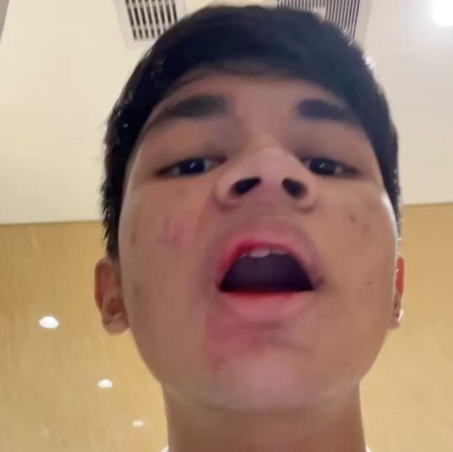 Muzakki Ramdhan Alami Kekerasan oleh Orang Tak Dikenal: Bibir Berdarah