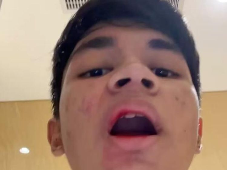 Muzakki Ramdhan Alami Kekerasan oleh Orang Tak Dikenal: Bibir Berdarah