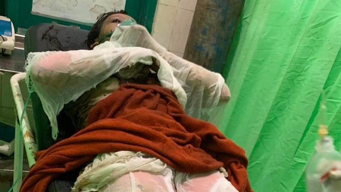 Siti Alami Luka Bakar 80 Persen Usai Dianiaya Mantan Suami Sirinya. (Istimewa)