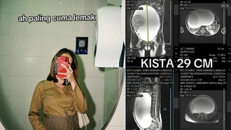 Viral Perut Wanita Bekasi Membesar Dikira Lemak, Ternyata Kista Ovarium 29 Cm