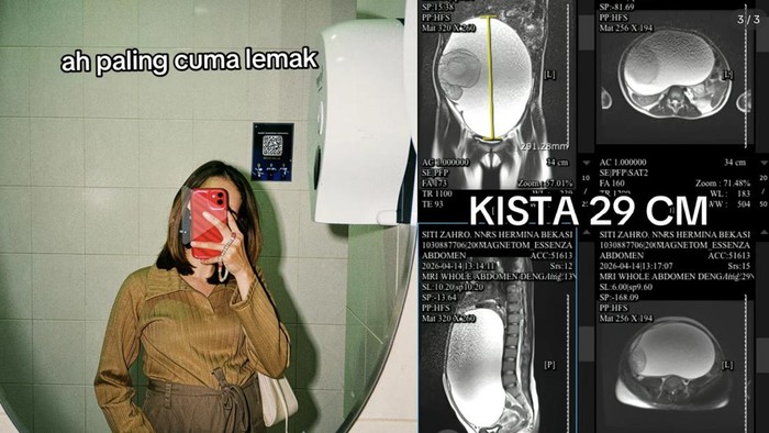 viral kista
